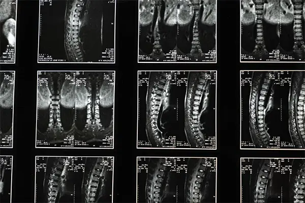 Spinal Medical Imaging